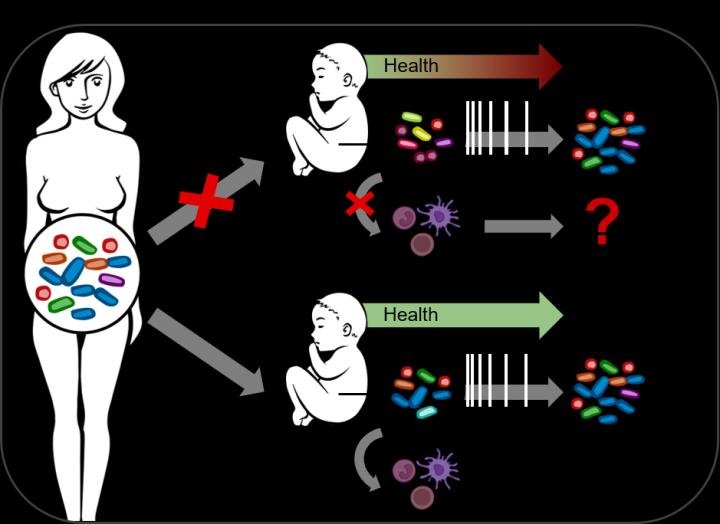 Altered microbiome after caesarean section impacts baby’s immune system